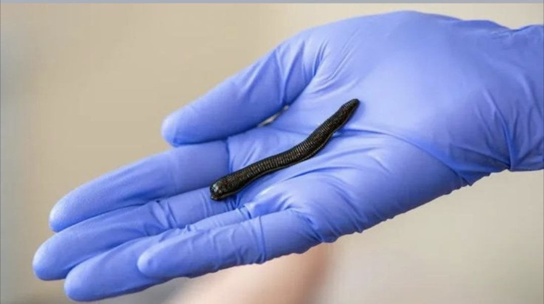 Гирудотерапия