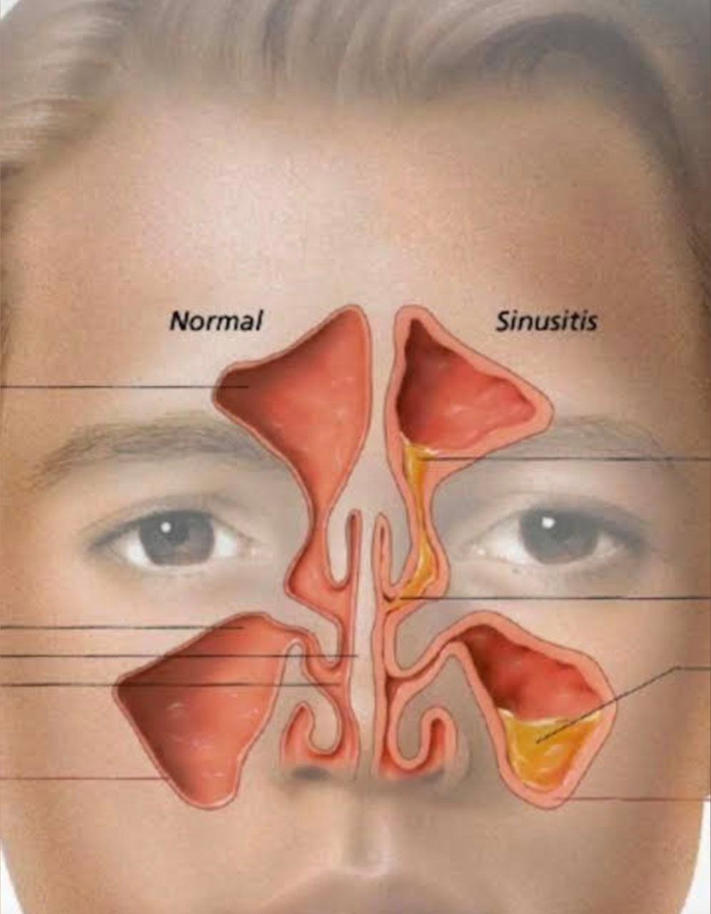 Насья — очистка пазух носа